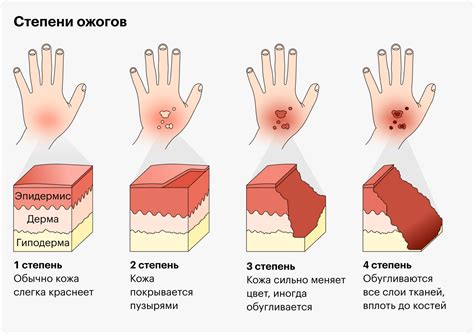 Ожоги и раздражение