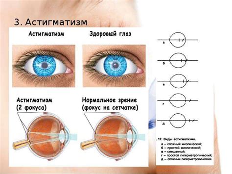 Онемение роговицы из-за неправильного подбора линз