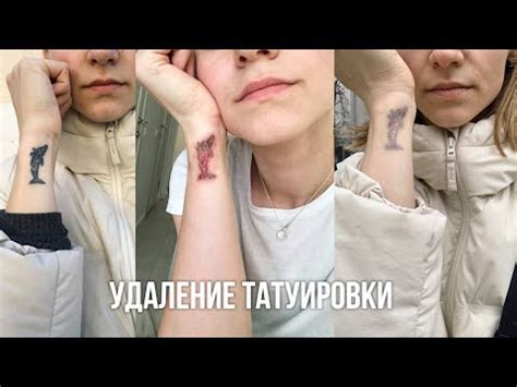 Опасности и риски при самостоятельном удалении свежей татуировки в домашних условиях