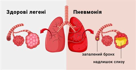 Опасность пневмонии у детей