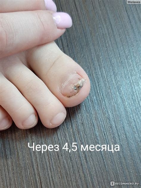 Опасность самостоятельного удаления ногтя