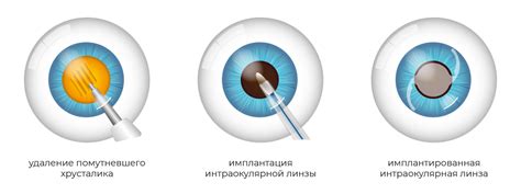 Операция на глаза: как выбрать процедуру