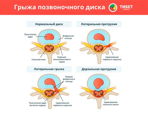 Определение и причины грыжи