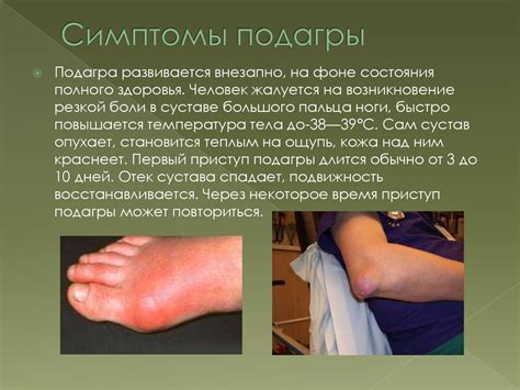 Определение подагры и ее симптомы
