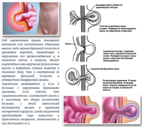 Определите тип грыжи