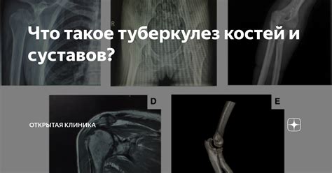 Ослабление костей и суставов