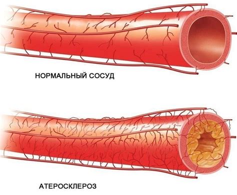 Ослабление сосудов: