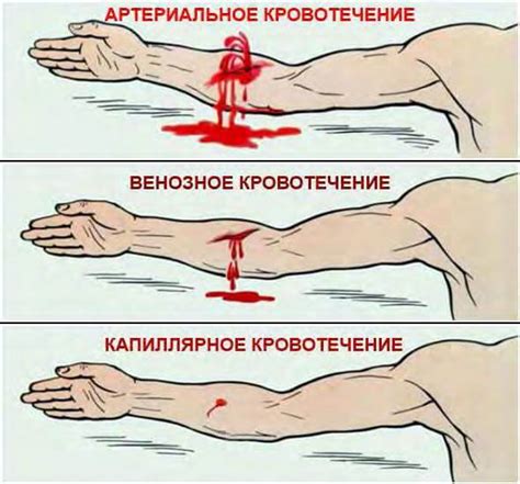 Осложнения кровотечения при приеме воды