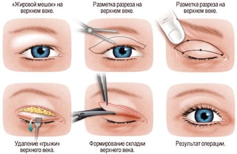 Основные виды операций на глаза: сравнение и отличия
