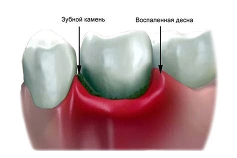 Основные методы лечения воспаления десен при простуде