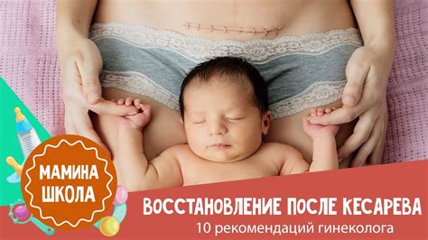 Основные ошибки при ходьбе по лестнице после кесарева сечения