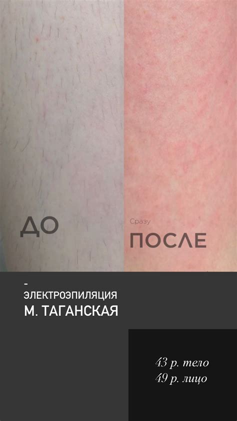 Основные правила ухода после электроэпиляции