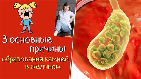 Основные причины образования камней
