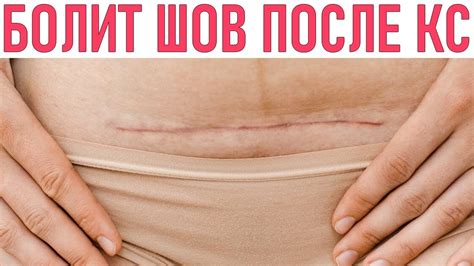Основные причины расслоения шва после кесарева