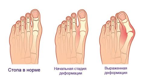 Основные симптомы и последствия косточки на ноге