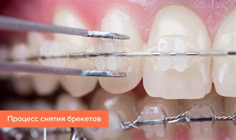 Оценка готовности для снятия брекетов