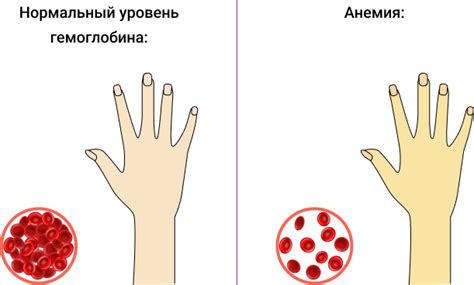 Паллор (бледность) кожи и слизистых