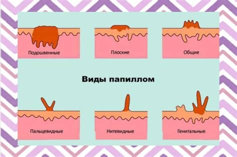 Папиллома в паховой области: вред и необходимость удаления
