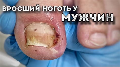 Первая помощь при врастании ногтя