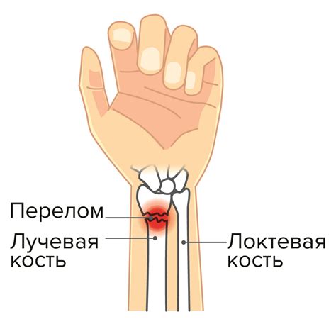 Перелом руки: когда происходит и как это происходит