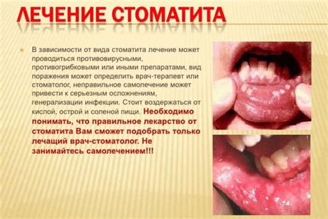 Питание и влияние на заживление стоматита