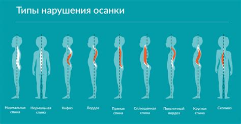 Плохая осанка и слабые мышцы
