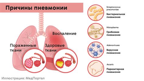 Пневмония: причины и симптомы