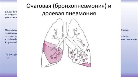 Пневмония: симптомы и причины