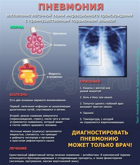 Пневмония как серьезное заболевание легких