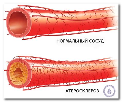 Повышенный стресс для сердца