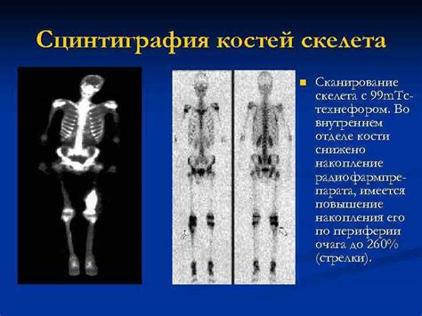 Подготовка костей
