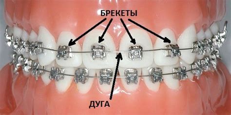 Поддержка результата после снятия брекетов