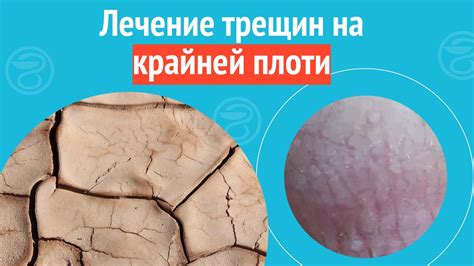 Подробное понимание трещины и ушиба