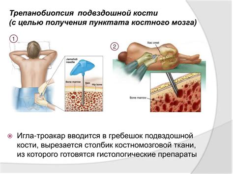 Покажем картину связанную с анестезии при методе извлечении костного мозга
