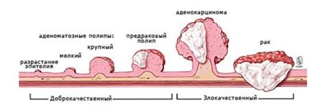 Полипы в толстой кишке