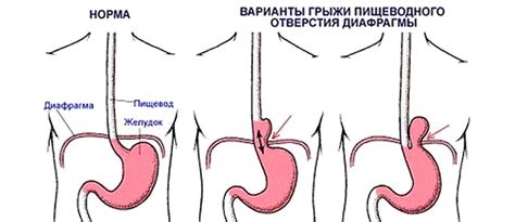 Польза голодания при грыже пищевода