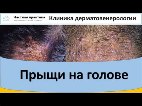 Понаследственность и неблагоприятные условия: причины возникновения гнойников на коже