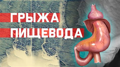 Понятие грыжи пищевода