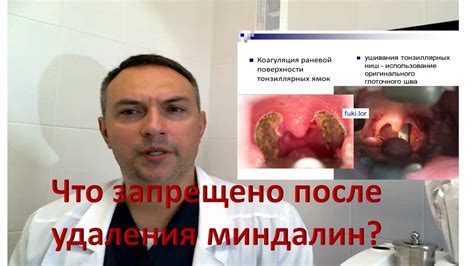 Последствия глотания крови после удаления 