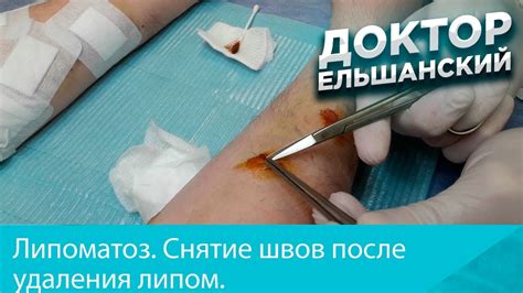 После удаления швов
