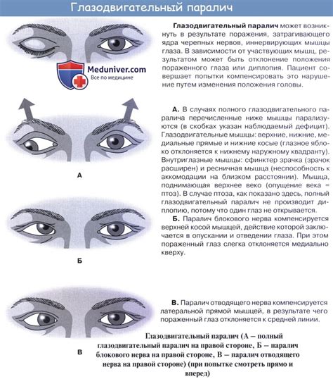 Постановка глазных яблок