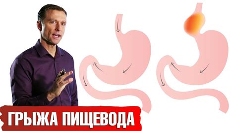 Потенциальные риски голодания при грыже пищевода