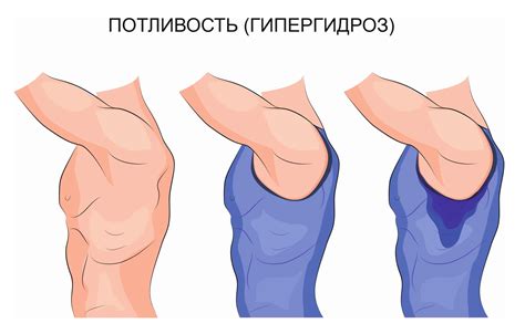 Потливость