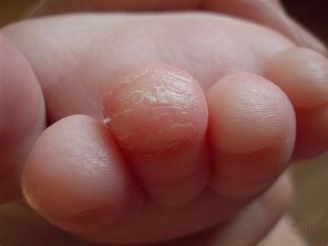 Почему происходит отшелушивание кожи на пальцах у ребенка 10 лет