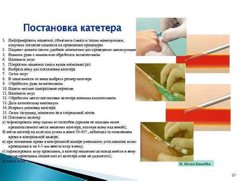 Пошаговая инструкция по установке шандоров