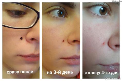 Предостережения и советы при самостоятельном удалении родинки под глазом