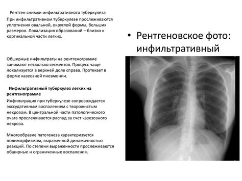 Предосторожности при проведении рентгена легких немладенцам