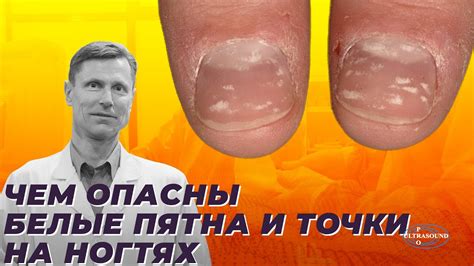 Предотвращение возникновения пятен куркумы на ногтях