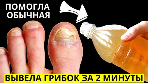 Предупреждение грибка ногтей: основные правила
