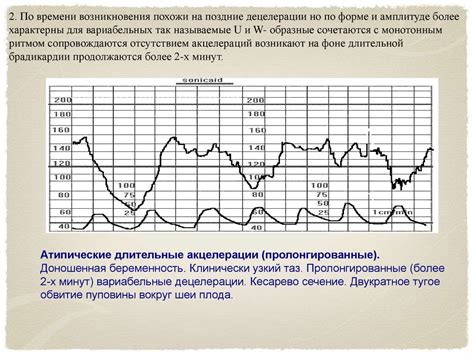 Преимущества диагностики схваток с помощью КТГ